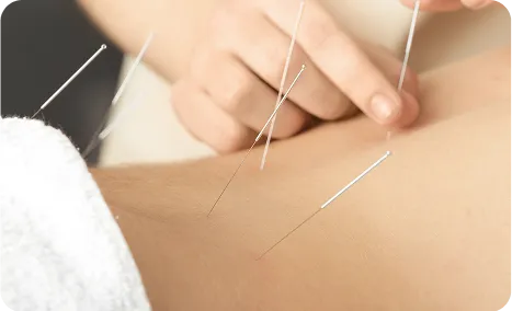 Acupuncture